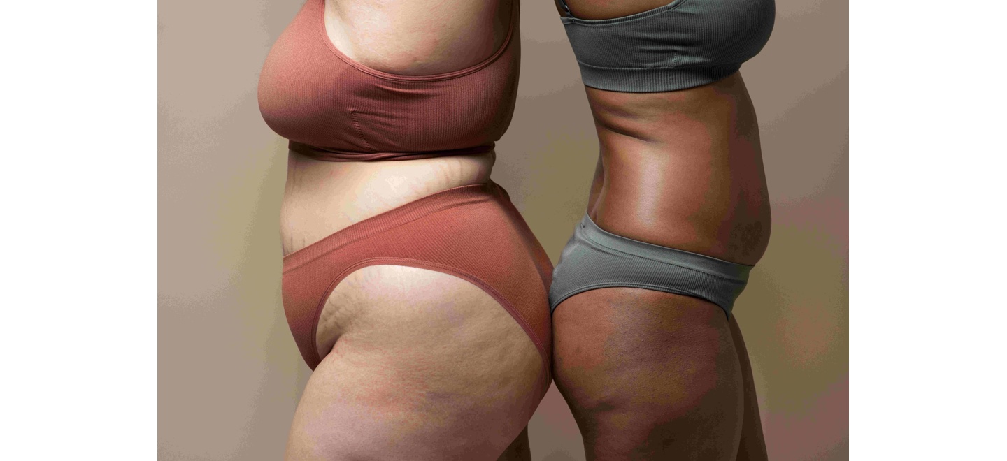 Gordura localizada: quais regiões do corpo são mais difíceis de diminuir?