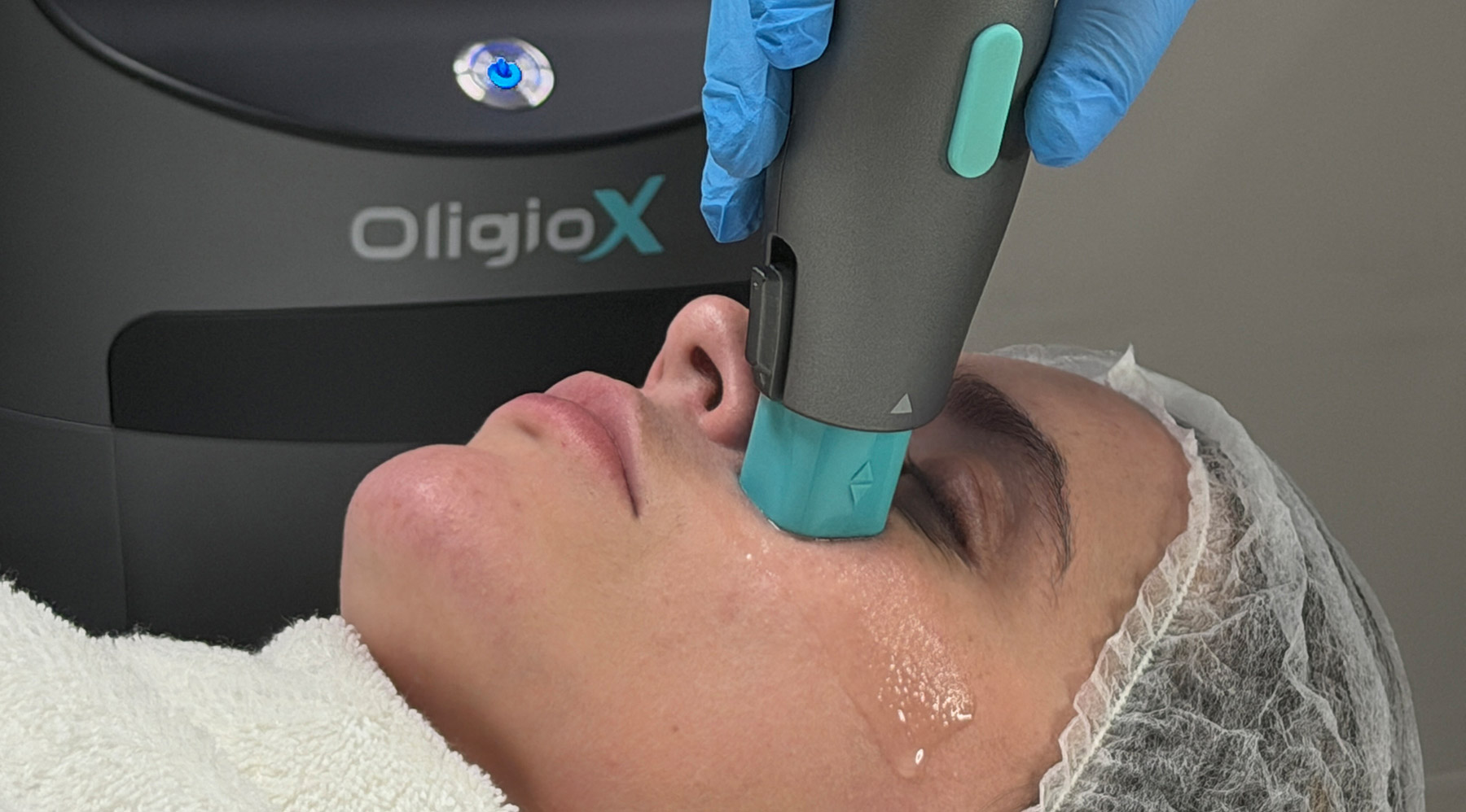 Sucesso nas clínicas médicas, OligioX une efeito lifting, contorno definido e firmeza com recuperação imediata