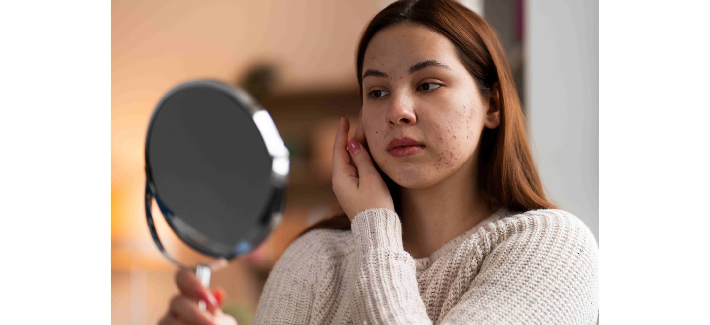 Inverno é a melhor época para tratar manchas? Conheça cinco benefícios do Peeling de Hollywood