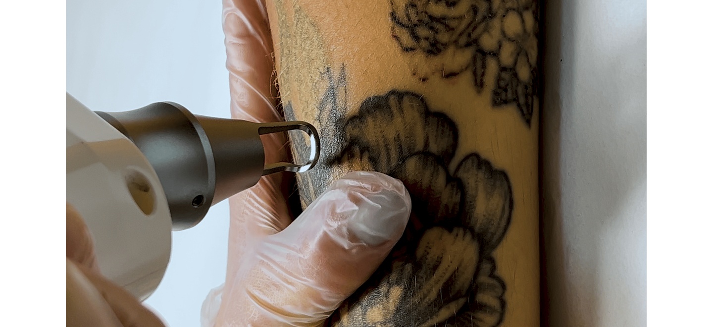 Mercado global de despigmentação deve atingir US$ 4,87 bilhões até 2034; entenda o avanço da remoção de tatuagens