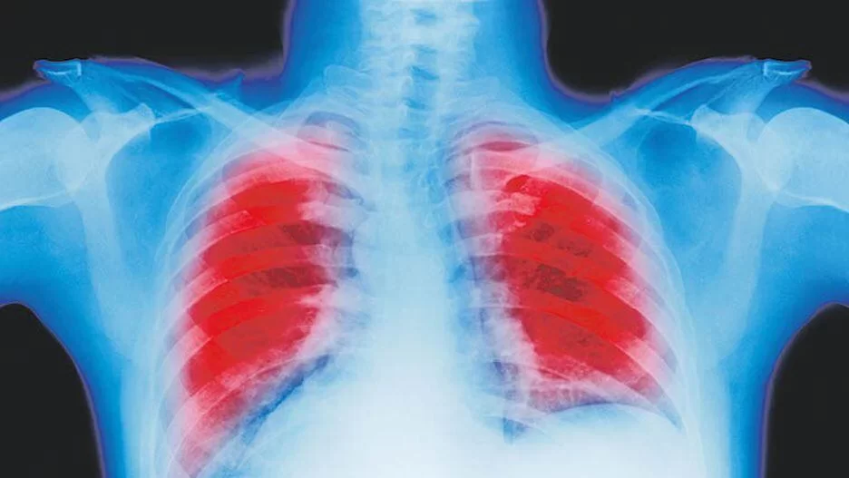 Câncer de pulmão custa R$ 1,3 bilhão ao País